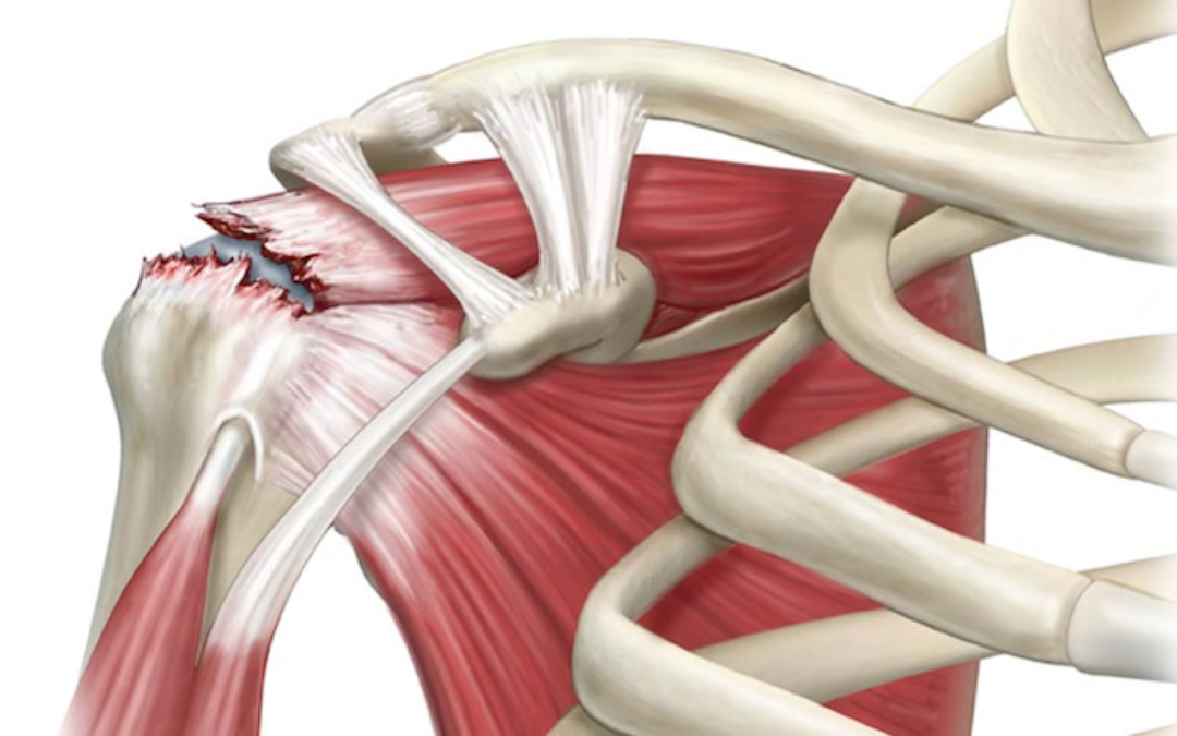 Lesões Da Cintura Escapular - Traumatologia E Ortopedia